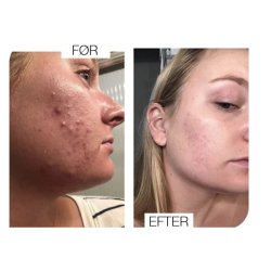 Breakout clearing foaming wash